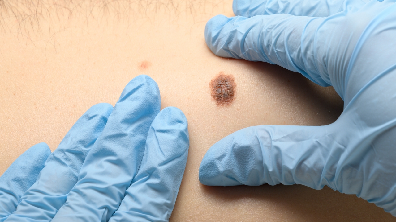 How to know in time if moles are malignant